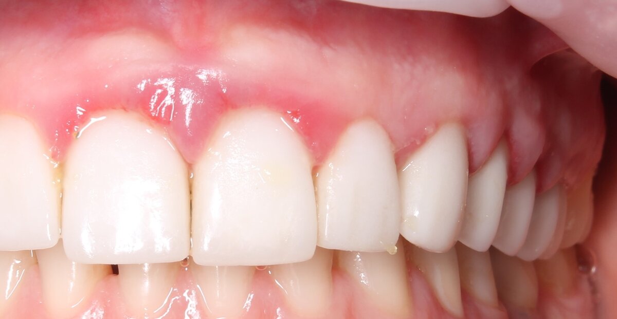 Лазерный кюретаж