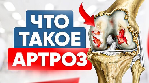 Download Video: Что такое артроз? Врачи хотят чтобы ваши суставы разрушились!