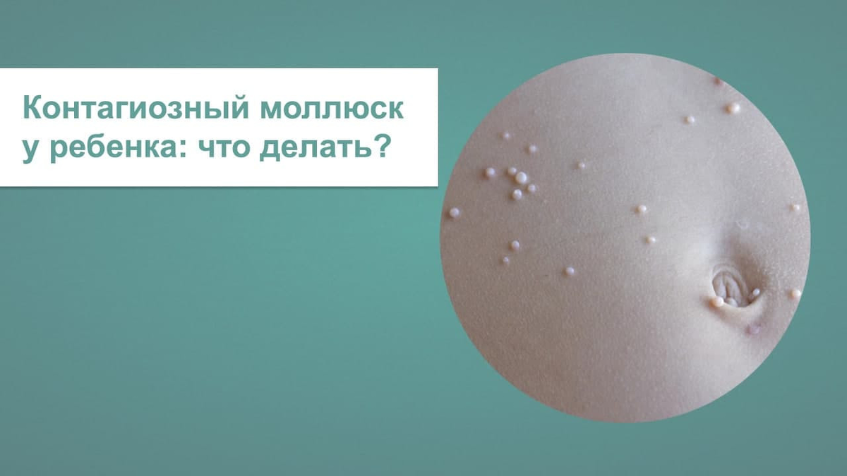 Как выглядит контагиозный моллюск на лице