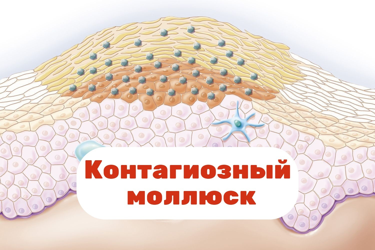 Мелкие «жемчужные» бугорки на коже детей – что такое контагиозный моллюск и  как его лечить | О детском здоровье: с врачебного на родительский | Дзен