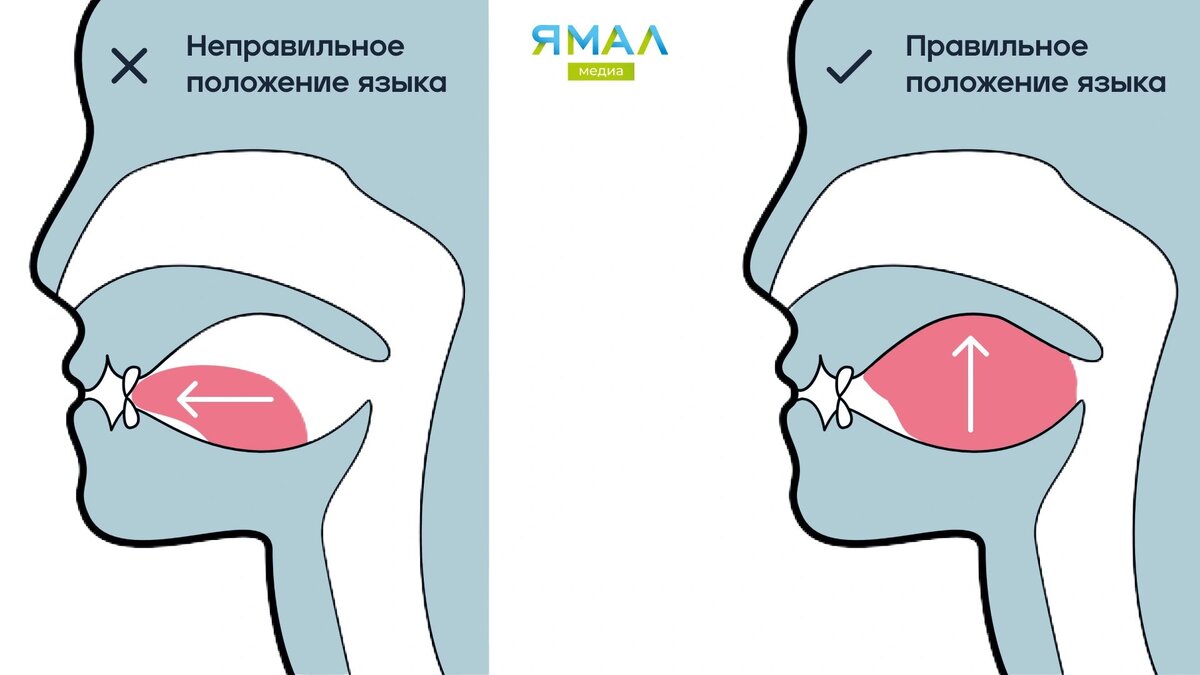 Держать язык за зубами: что такое мьюинг и как он поможет исправить прикус  | Время Новостей | Дзен