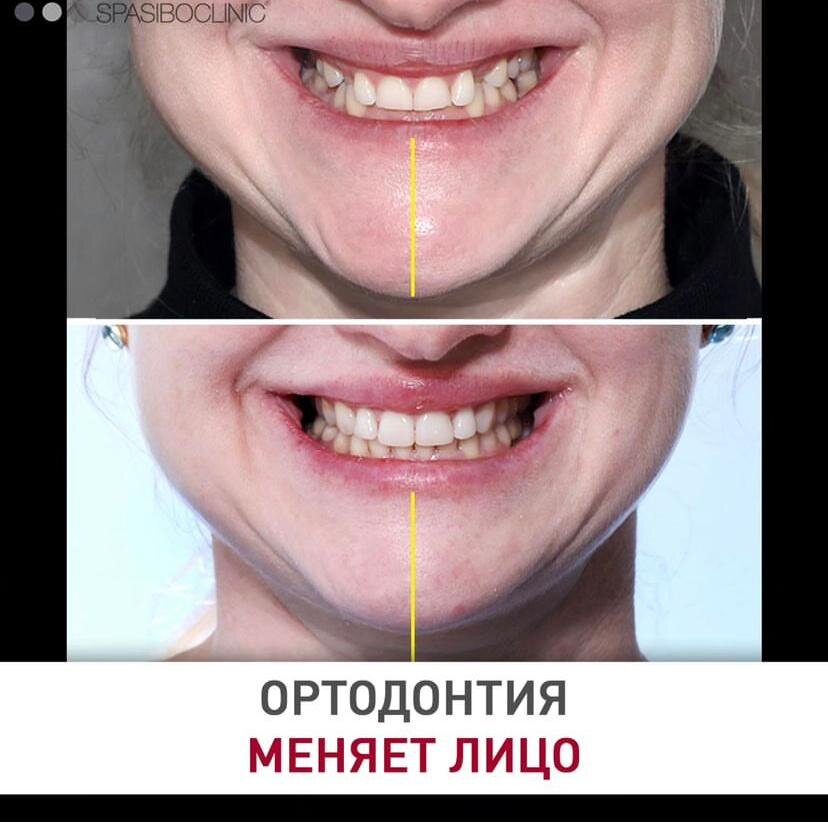 Правильная ортодонтия разгружает челюсти и мышцы🤓
Устранили блок нижней челюсти, вернули зубы в правильное положение.
Лицо и улыбка стали более расслабленными, подбородок выровнялся.