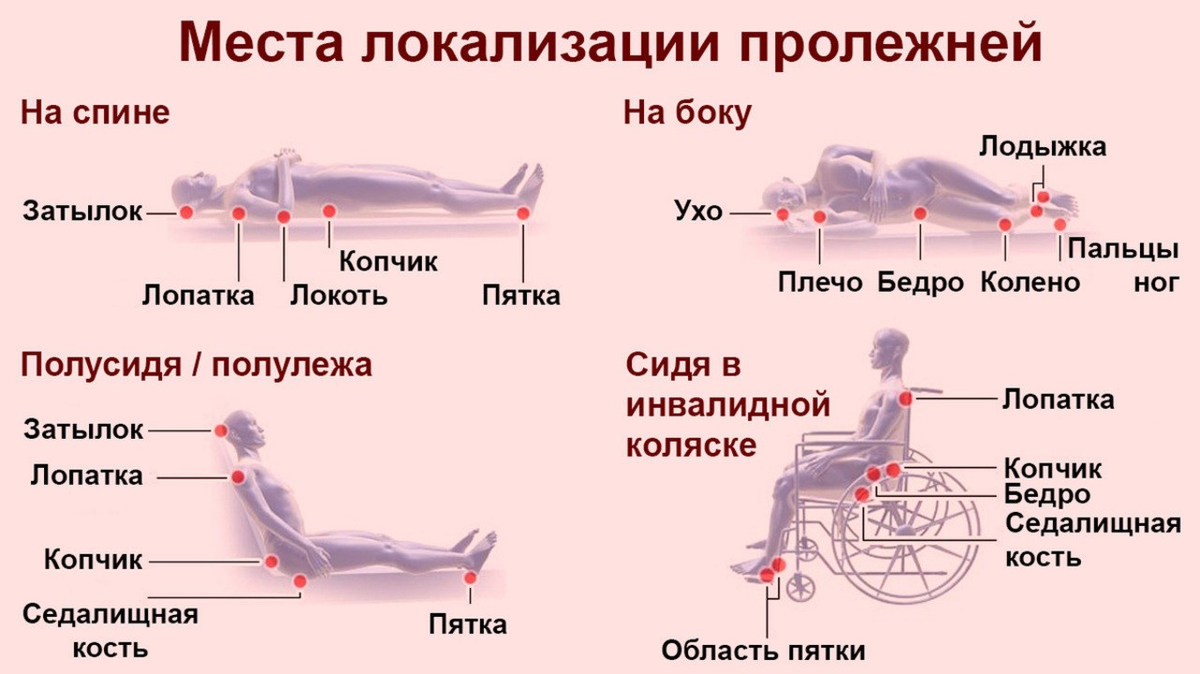 Профилактика пролежней у лежачих пожилых людей | Социальный проект 