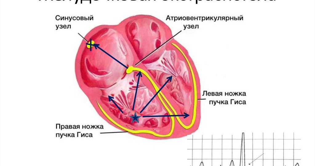 Чем опасны желудочковые экстрасистолы?