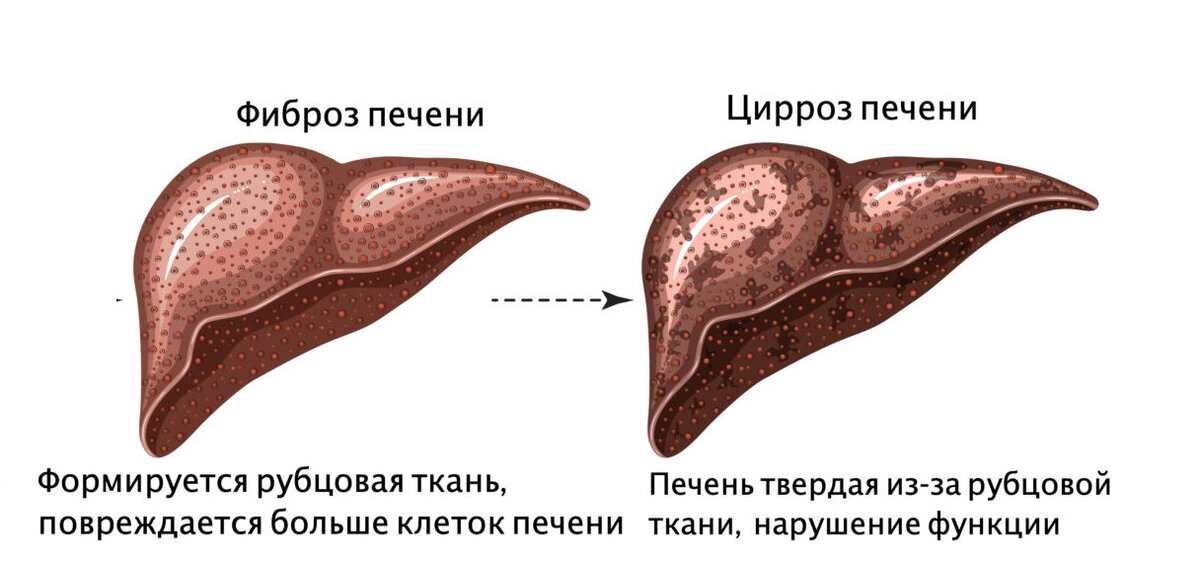 Тест болезнь печени