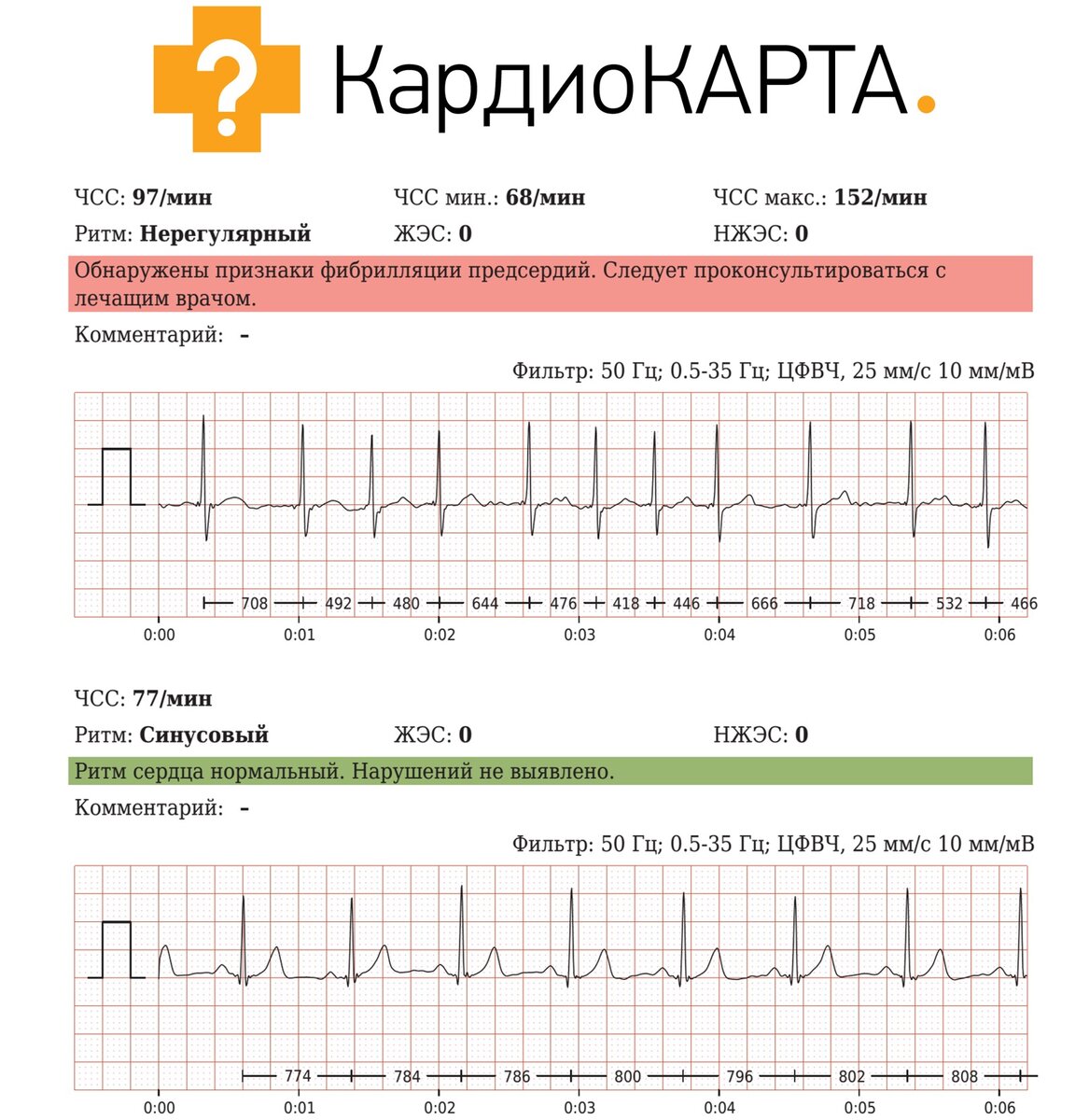 Что делать дома с мерцательной аритмией? Или жизнь после больницы! |  КардиоКАРТА | Кардиология | Дзен