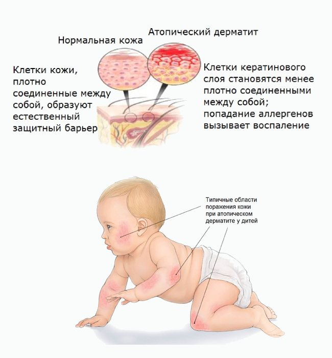 Атопический дерматит у детей фото лечение