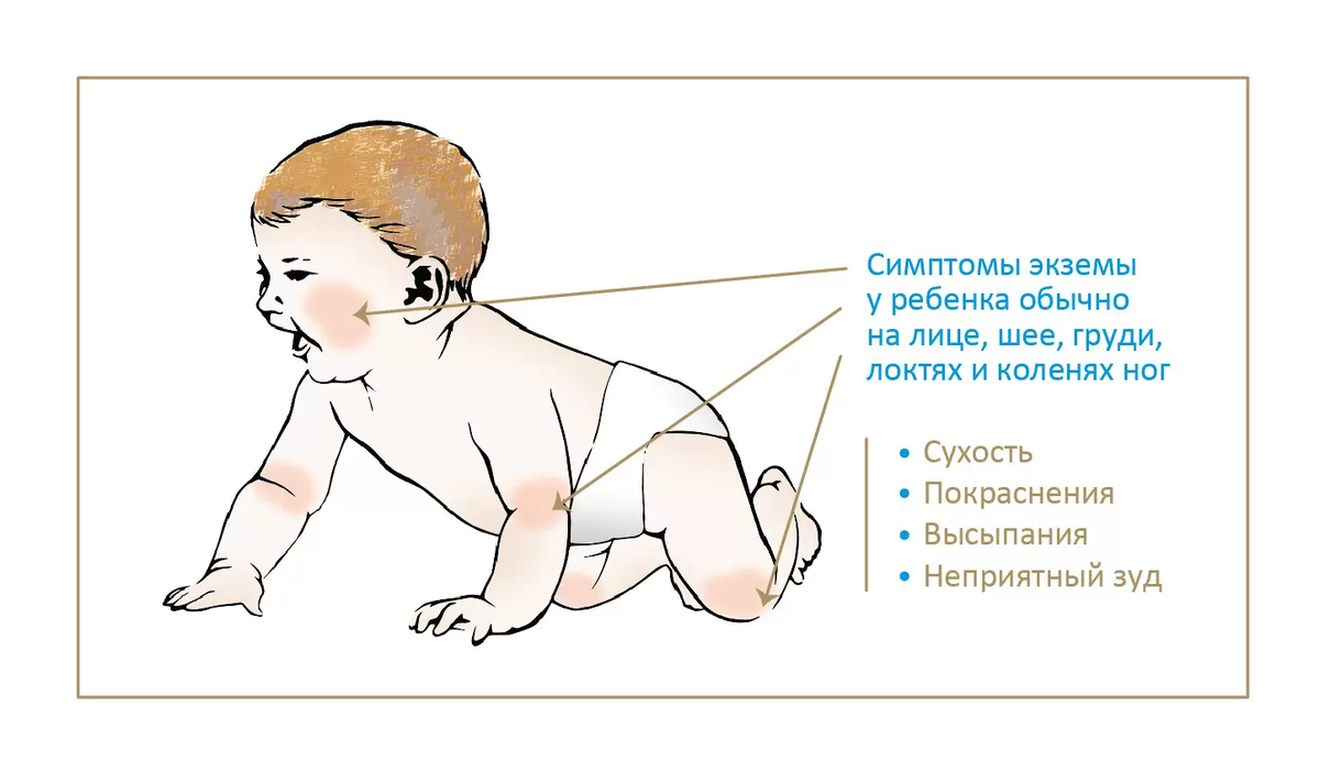 Атопический дерматит у детей: красные щеки, корки на лице и теле, проблемы  с едой | О детском здоровье: с врачебного на родительский | Дзен