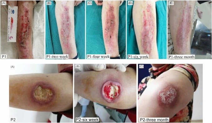 Рис. 1. Два типичных случая заживления ран после фотодинамической терапии. Пациент 1. Хроническая рана после ожога. (A. Рана с обширным ожогом на коже голени до лечения; B. Через две недели после трех сеансов ФДТ; C. Через четыре недели после ФДТ; D. Через шесть недель после ФДТ; E. Через три месяца после ФДТ). Пациент 2. Хроническая инфекционная рана при дерматомиозите. (A. Язва на коже разгибательной поверхности левого предплечья до лечения; B. Через шесть недель после трех сеансов ФДТ; C. Через три месяца после ФДТ) Первоисточник - Chen P, Zou Y, Liu Y, Han W, Zhang M, Wu Y, Yin R. Low-level Photodynamic Therapy in Chronic Wounds. Photodiagnosis Photodyn Ther. 2024 Apr 11:104085. 
https://pubmed.ncbi.nlm.nih.gov/38614272/