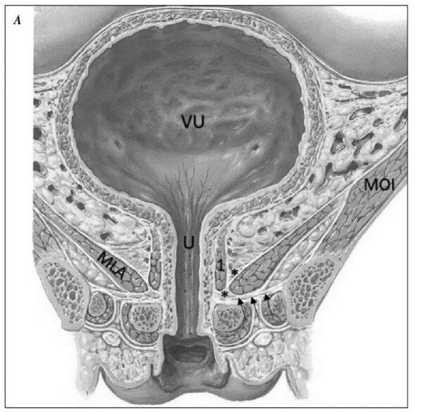 Посмотрите на рисунок продольного среза таза. Обратите внимание на расположение m. levator ani (MLA). Представьте как их сокращение (естественным образом) будет поднимать мочевой пузырь (VU) вверх.