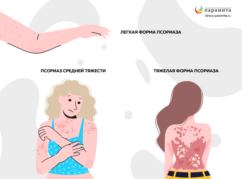 Степени тяжести псориаза
