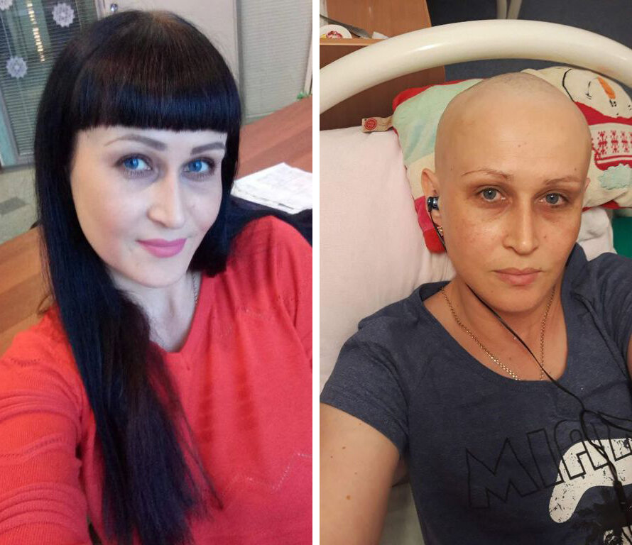 Красавица Анастасия, мама троих детей, до лечения и во время прохождения лекарственной терапии. С густым длинным волосом, увы, пришлось попрощаться.