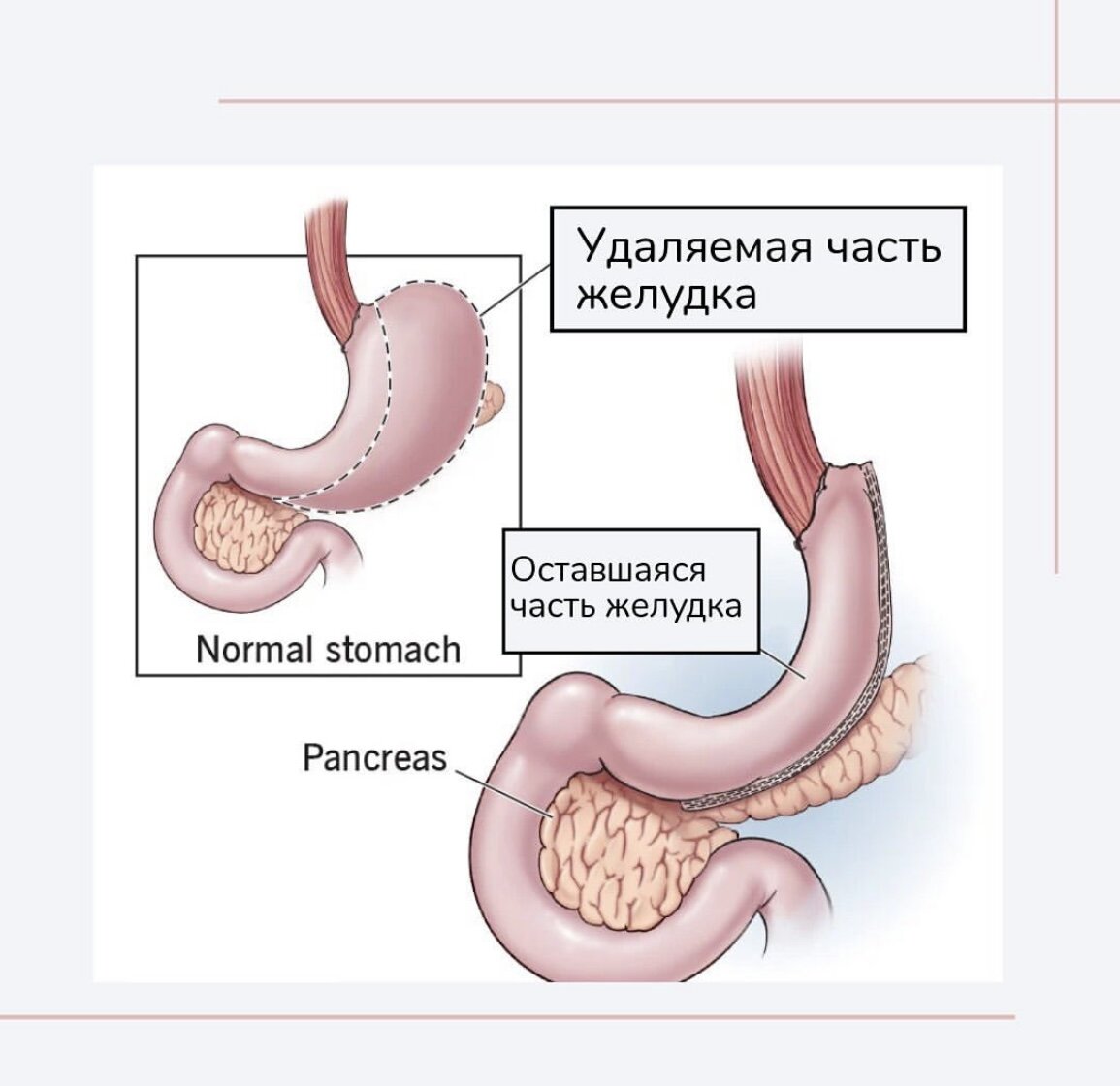 Самая распространенная бариатрическая операция | med122 | Дзен