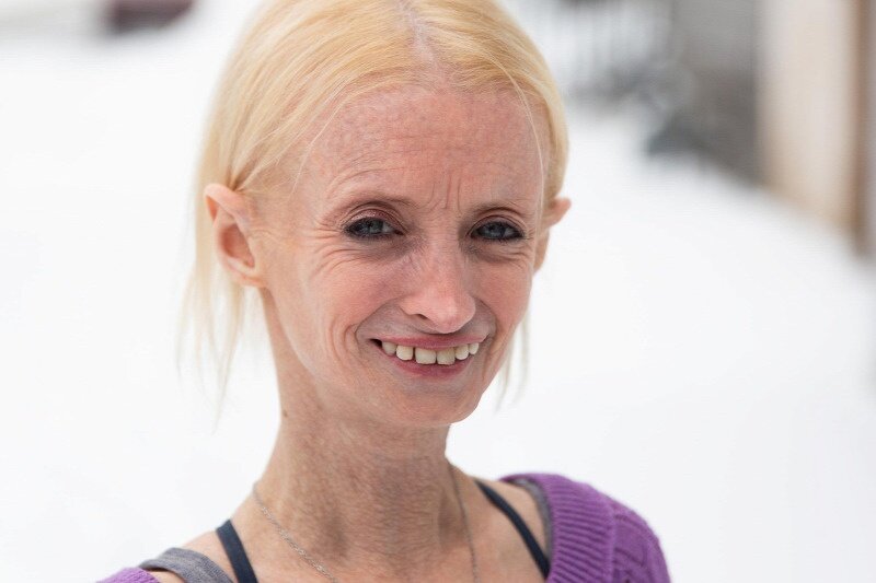 Пациентка с прогерией взрослого типа