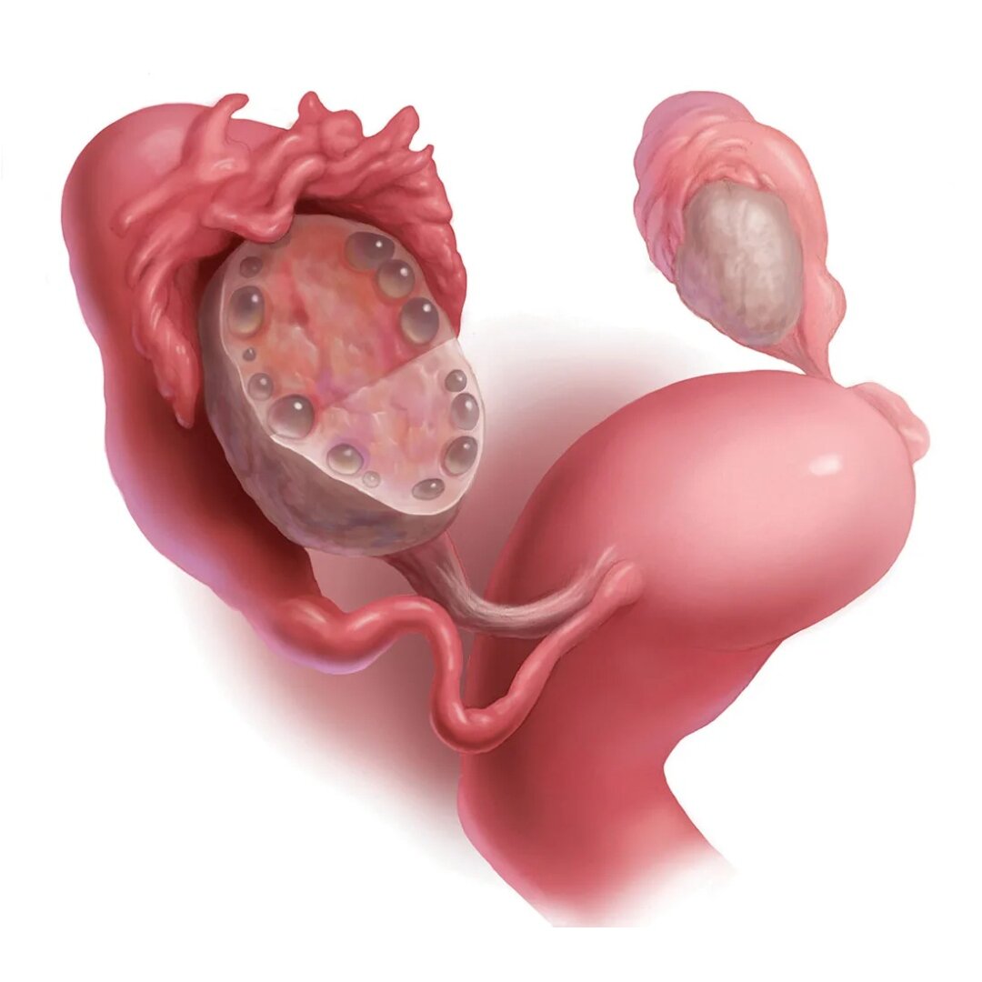 Поликистозные яичники