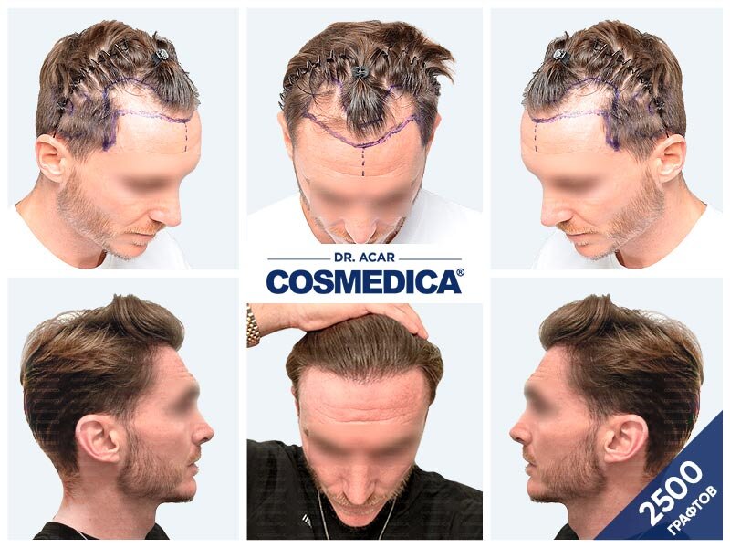 Пересадка волос до и после 2500 графтов, фото клиники Cosmedica