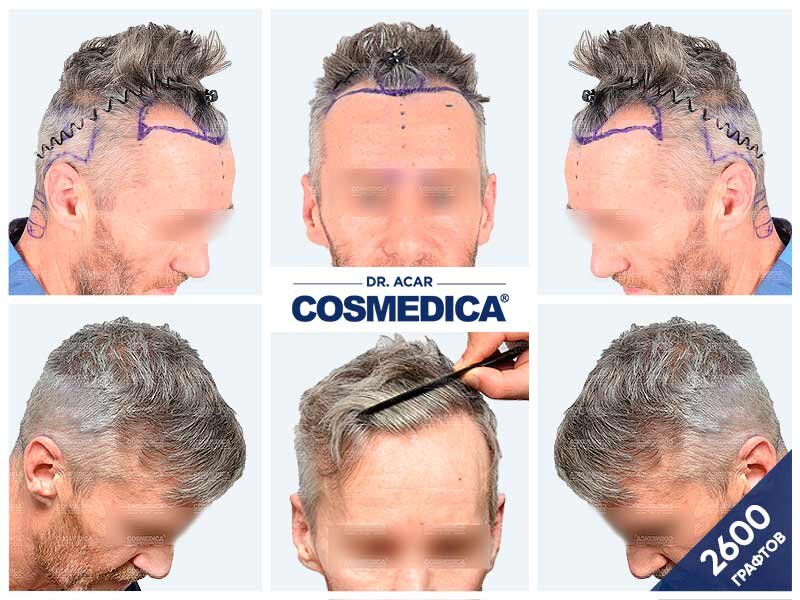 Пересадка волос до и после 2600 графтов, фото клиники Cosmedica