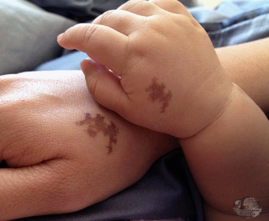 Родимые пятна