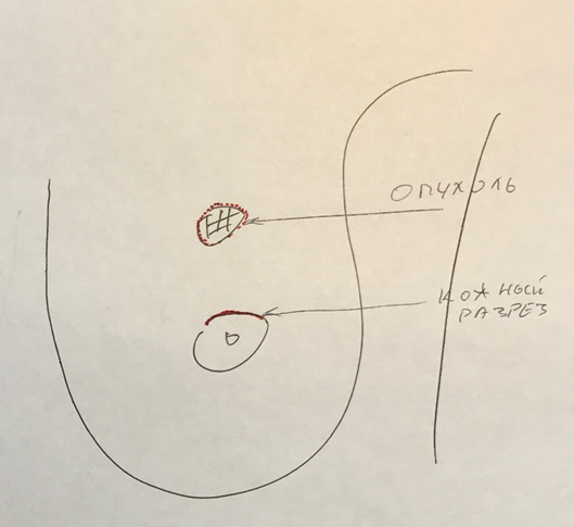 Рисунок 1. Схема удаления фиброаденомы, пунктиром показан объём удаляемой ткани.