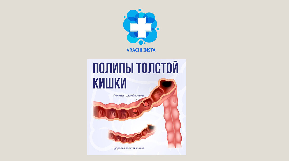 Всё, что вам нужно знать о полипах толстой кишки | Vrachi.insta | Дзен