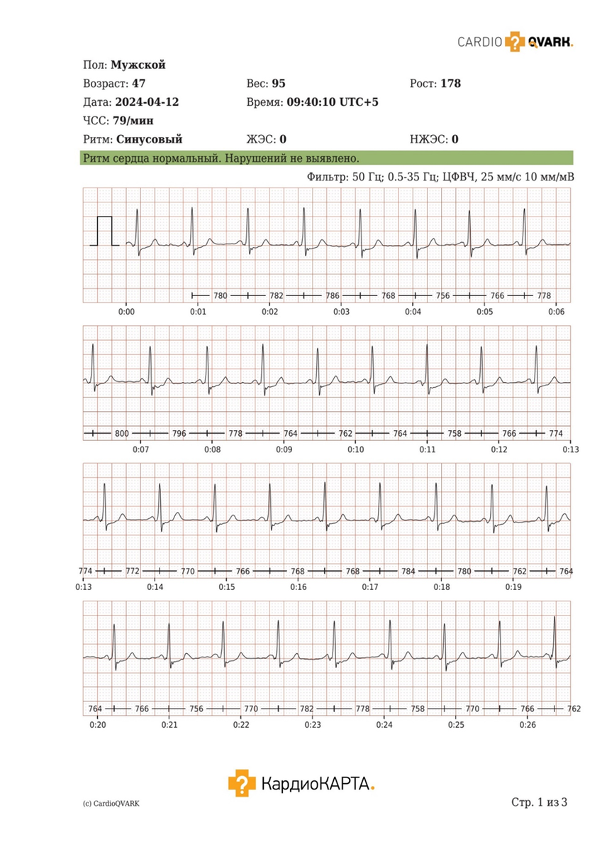ЭКГ при изменении сегмента ST и зубца Т. КардиоКАРТА. Стр. 1: Лента ЭКГ