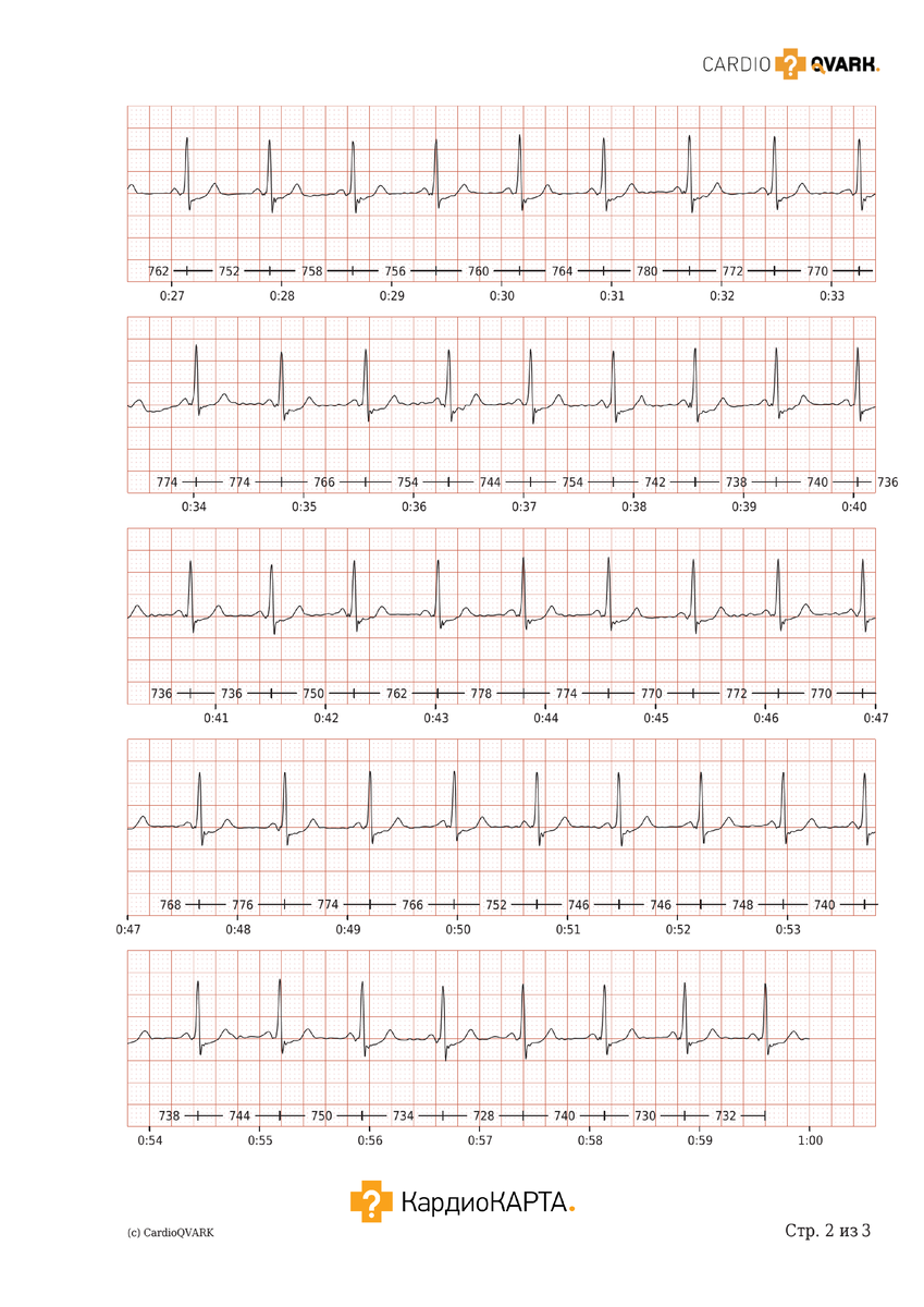 ЭКГ при изменении сегмента ST и зубца T. КардиоКАРТА. Стр. 2: Лента ЭКГ