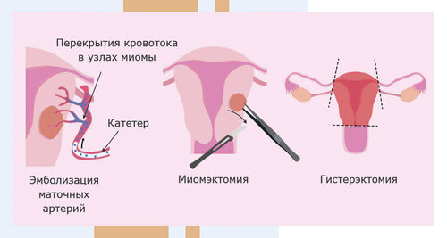 Способы удаления миомы матки