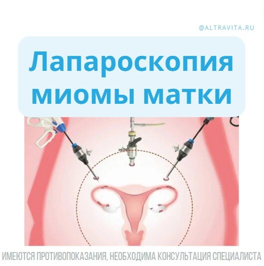 Лапароскопия миомы матки