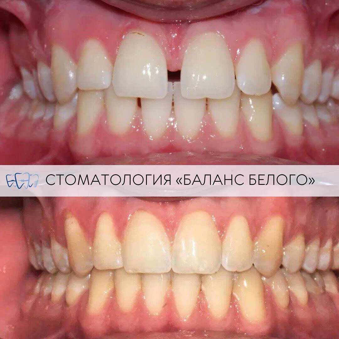 Установка брекетов Москва