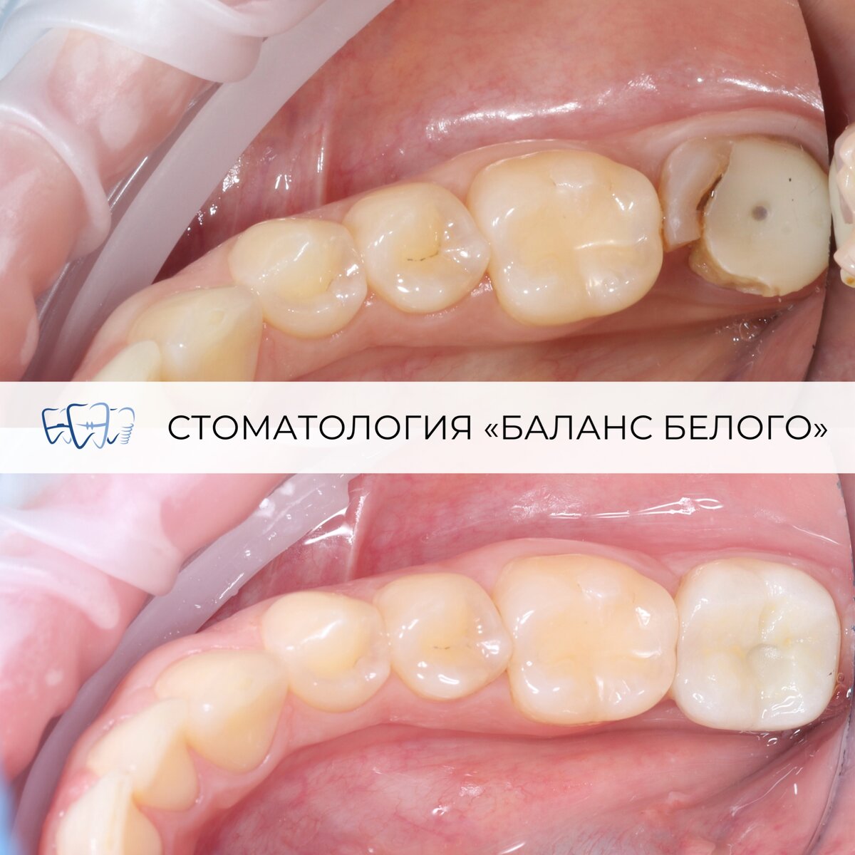 Одномоментная имплантация