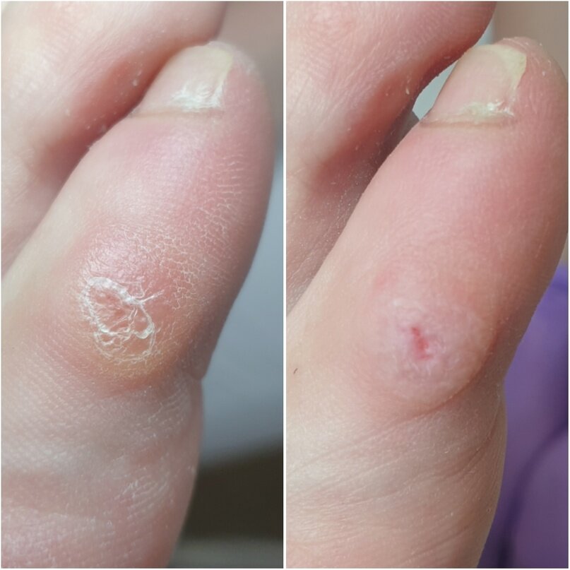 Стержневая мозоль: как вылечить ее правильно, чтобы избежать осложнений ...