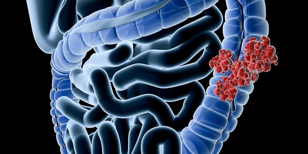 ОПЕРАЦИИ ПРИ РАКЕ ОБОДОЧНОЙ КИШКИ