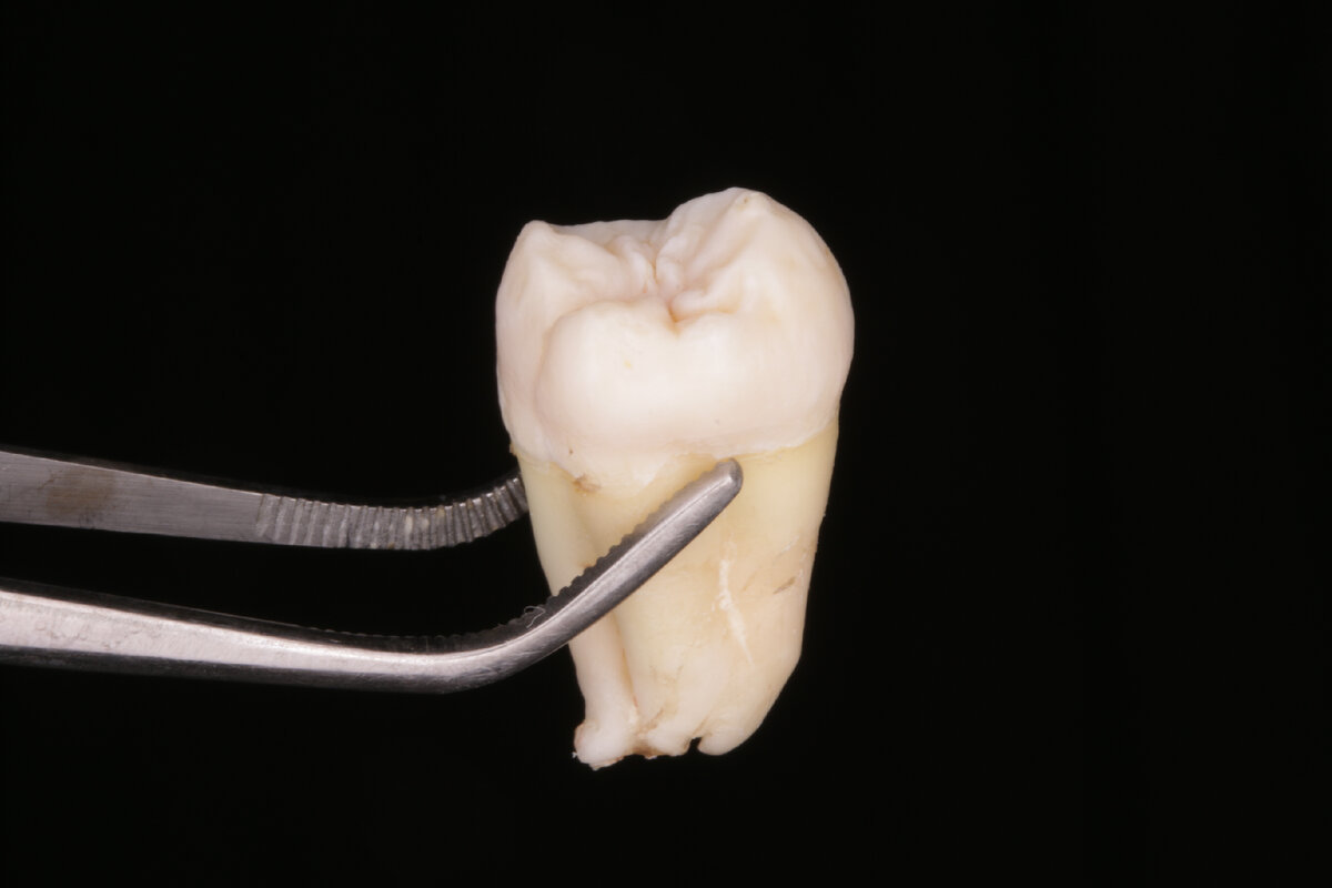 Удаленный зуб мудрости: фото сделано в клинике авторской стоматологии White Art