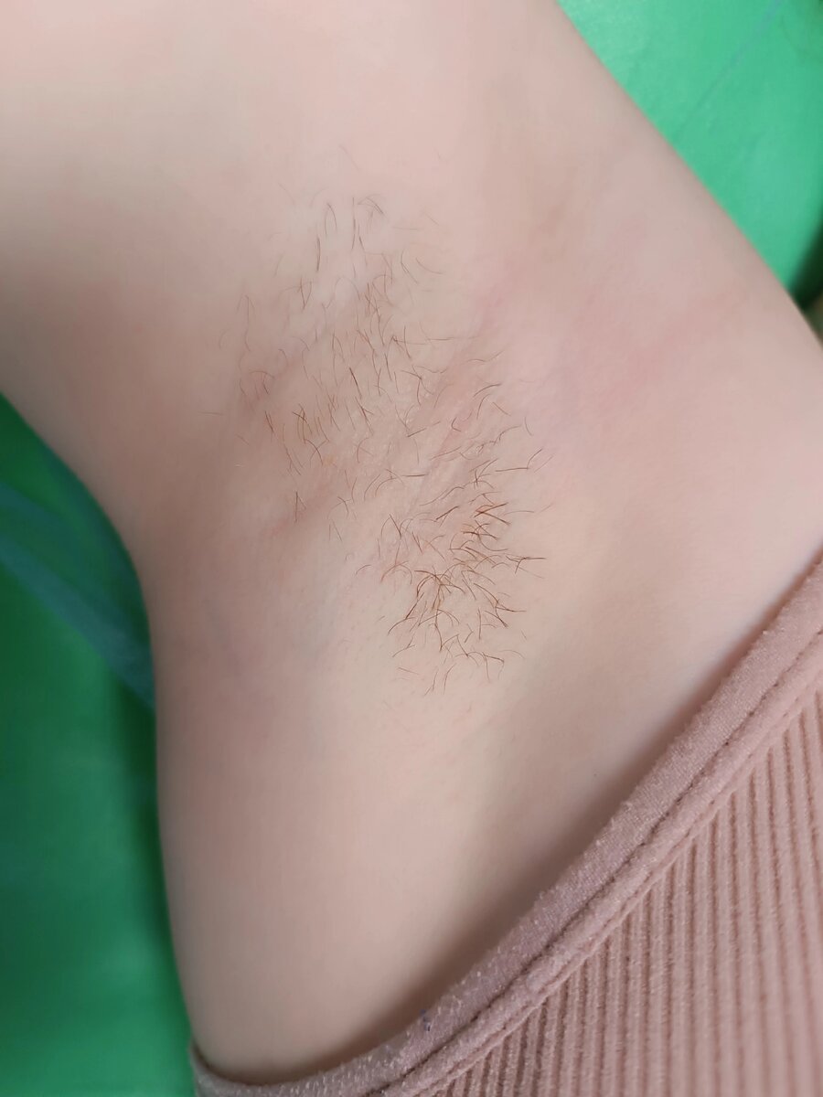 Фото автора канала, перед депиляцией 