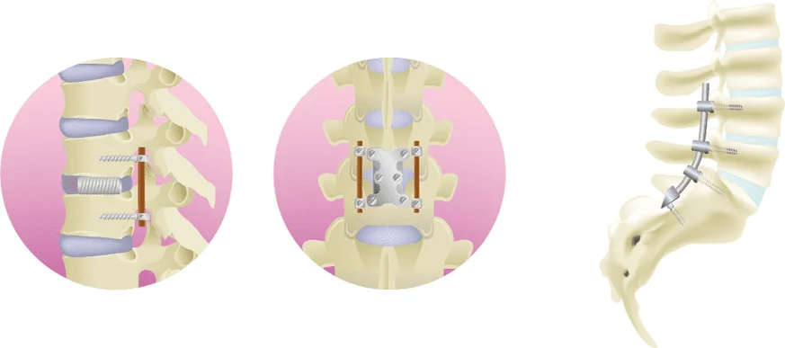 Лечение стеноза позвоночного канала | International Lumbago Clinic | Дзен
