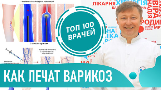 Download Video: Лечение варикоза. Лучший метод как лечить варикоз на ногах. Варикозное расширение вен