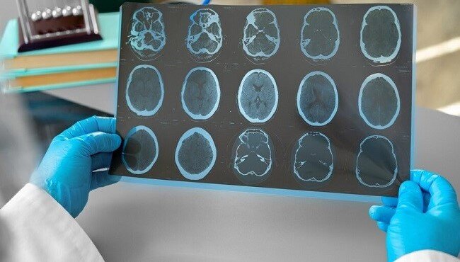 Обследование позволяет выявить факторы риска развития инсульта 