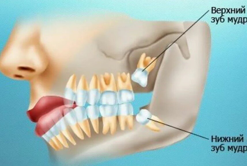 расположение зубов мудрости
