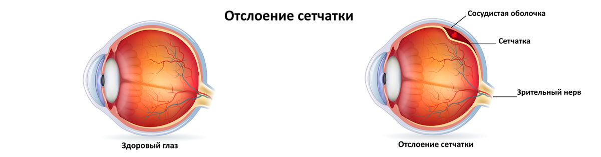 Чем опасен макулярный разрыв сетчатки - статья по теме Офтальмология - МЦОЗ