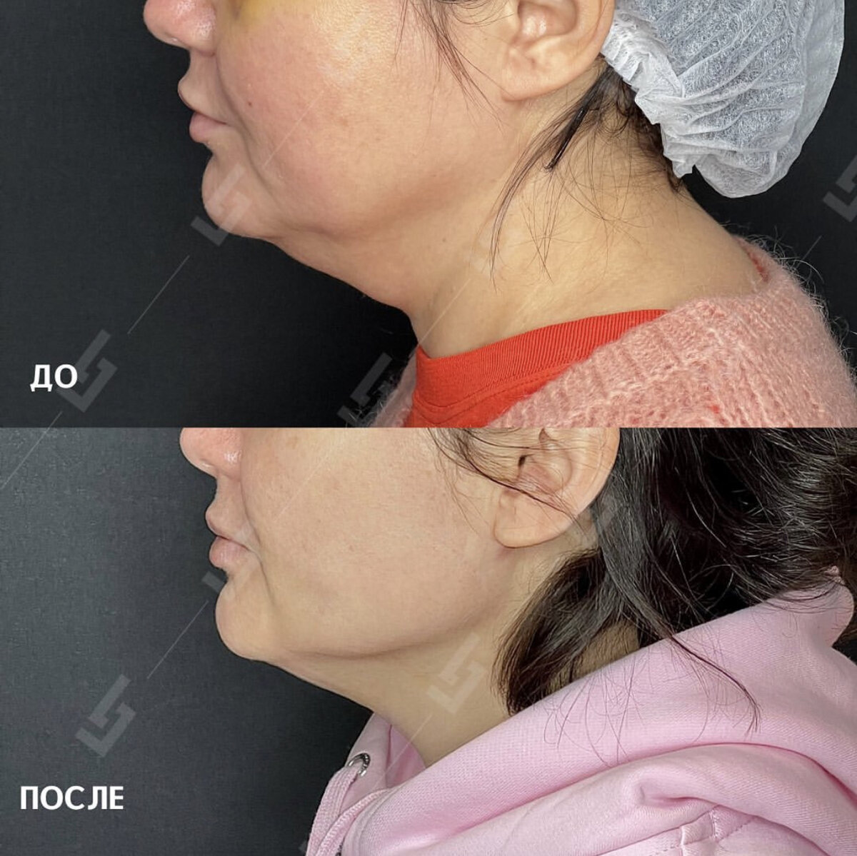 Лицо до и после фейс тайт