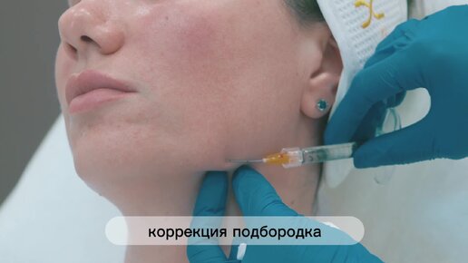 Коррекция подбородка препаратом BioHyalux Deep Dermis