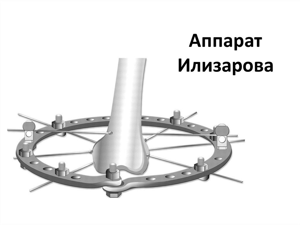 Устройство было предложено в 1950 году советским ортопедом, хирургом Илизаровым Гавриилом Абрамовичем, в 1952 году изобретение было запатентовано как метод терапии переломов костей.