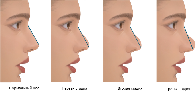 Деформация поллибека