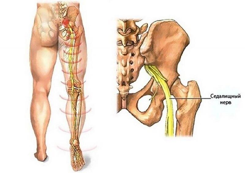 Седалищный нерв. Защемление седалищного нерва гимнастика. Грыжа позвоночника защемление нерва. Седалищный витамины. Сидалеч седалищный нерв.