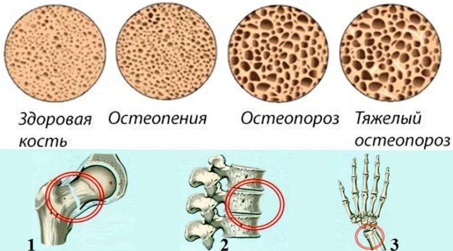 Снижение плотности костей