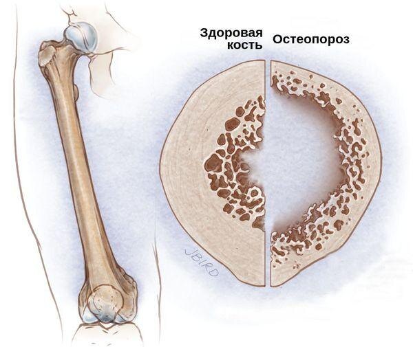 Последствия остеопороза