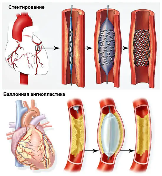 Атеросклероз и стенокардия. Коронарное стентирование сосудов сердца. Стентирование сосудов коронарных артерий. Чрескожная ТРАНСЛЮМИНАЛЬНАЯ коронарная ангиопластика. Баллонная ангиопластика и стентирование коронарных артерий.