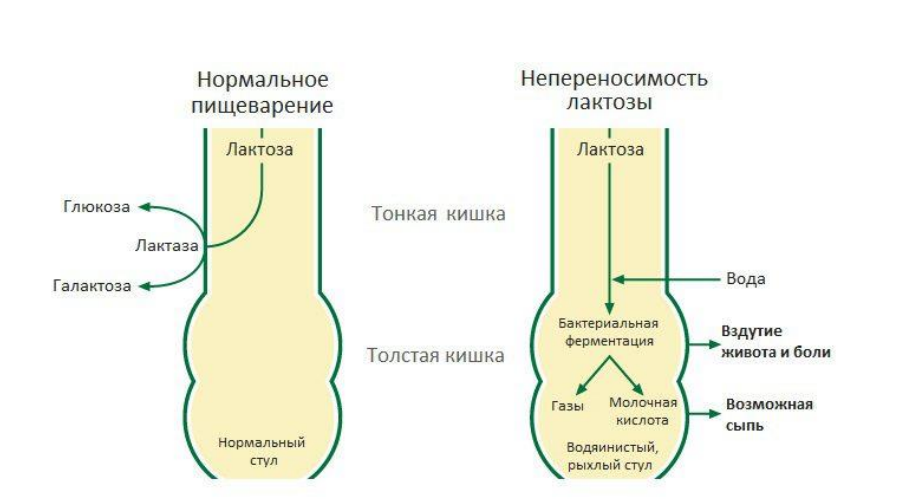 Лактазная недостаточность результаты. Лактогенная недостаточность у новорожденного. Как проявляется непереносимость лактозы у взрослых симптомы. Кал при лактозной недостаточности у новорожденных. Стул новорожденного при лактозной недостаточности.