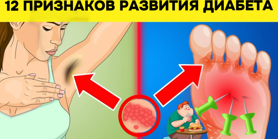 12 ранних признаков развития сахарного диабета, которые требуют особого внимания со стороны врачей