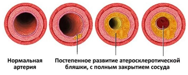 Формирование холестериновой бляшки